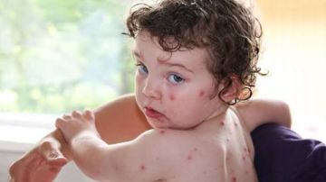 بعد إصابة 18 طالبا بالجدري المائي في مدرسة بالمنوفية.. أعراض المرض وطرق الوقاية بعد إصابة 18 طالبا بالجدري المائي في مدرسة بالمنوفية.. أعراض المرض وطرق الوقاية