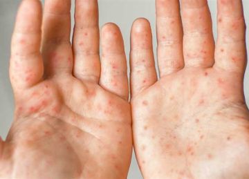 فيروس اليد والفم والقدم HFMD .. نداء عاجل من الصحة بعد إغلاق فصل دراسي