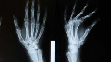 غراء عظمي يغنى عن الجراحة الصين تبتكر تكنولوجيا حديثة لمعالجة الكسور خلال 3 دقائق غراء عظمي يغنى عن الجراحة الصين تبتكر تكنولوجيا حديثة لمعالجة الكسور خلال 3 دقائق