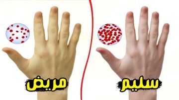 أعراض نقص الحديد..7 مؤشرات خطيرة