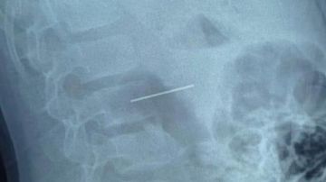استخراج مسمار دباسة اخترق بطن طـ.فل بمستشفى الأطفال التخصصي بنها
