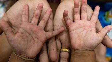 الصحة تطمئن أولياء الأمور: لا يوجود خطورة من مرض اليد والفم والقدم الصحة تطمئن أولياء الأمور: لا يوجود خطورة من مرض اليد والفم والقدم