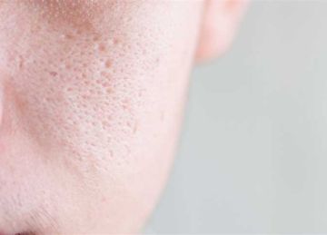 لعلاج المسام الواسعة.. ماذا تضع على وجهك؟
