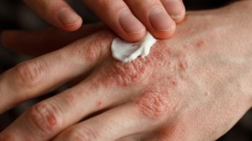 مش مجرد مشاكل جلدية.. احذر مضاعفات مرض الصدفية