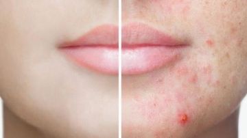 مش هرمونات ولا نظافة.. اكتشف أسباب ظهور علامات حب الشباب