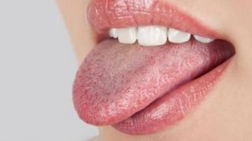 علاج فطريات الفم بطرق طبيعية آمنة.. حلول منزلية فعالة