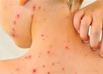 بعد ظهور الجدري المائي في إحدى المدارس تعرف على الأعراض وطرق العلاج