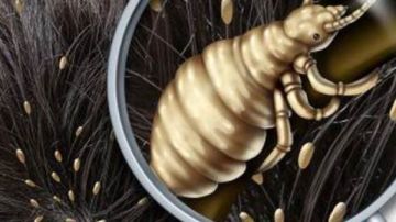 قمل الرأس.. إزعاج متكرر بين الأطفال وطرق فعالة للوقاية والعلاج