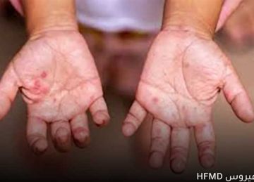 بعد ظهور 4 حالات مصابة بفيروس HFMD ..متى يجب زيارة الطبيب ؟ بعد ظهور 4 حالات مصابة بفيروس HFMD ..متى يجب زيارة الطبيب ؟