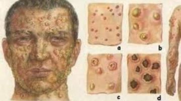 ليبيا.. تسجيل إصابات بـ الركيتسيا وسط تحذيرات من تحوله لوباء ليبيا.. تسجيل إصابات بـ الركيتسيا وسط تحذيرات من تحوله لوباء