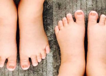 ما أسباب تورم القدمين؟ قد يكون مؤشر على مشاكل في الكلى