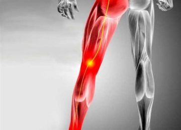 بدون جراحة.. أفضل طريقة لعلاج ألم عرق النسا