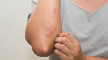 مجدي بدران: لا لقاح لحساسية البرد والوقاية تبدأ من السلوكيات الصحية