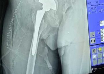 بـ استبدال مفصل وترقيع .. نجاح فريق طبي في إجراء جراحة دقيقة لمريض بجمال عبدالناصر في الإسكندرية