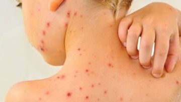 ارتفاع عدد الأطفال المصابة بالجدري المائي إلى 24 حالة بمدرسة في المنوفية