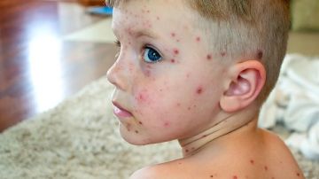 زيادة إصابات الجديري المائي بمدرسة المنوفية لـ24 وعزل المصابين 10أيام وتطهير الفصول زيادة إصابات الجديري المائي بمدرسة المنوفية لـ24 وعزل المصابين 10أيام وتطهير الفصول