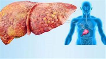 أعراض مرض الكبد الدهني.. القائمة الكاملة