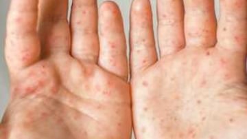 بعد حالة الهلع.. الصحة و التعليم توضحان حقيقة انتشار مرض اليد والقدم والفم بين الأطفال فيديو