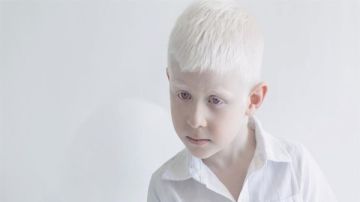 مش بس شعر أبيض .. تعرف على أشكال وأنواع مرض الألبينو مش بس شعر أبيض .. تعرف على أشكال وأنواع مرض الألبينو