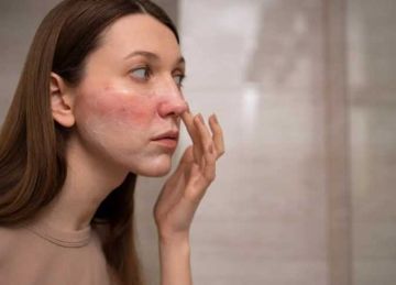 هل تعاني من احمرار متكرر وحرقان في الوجه؟.. 5 أسباب وراء ذلك هل تعاني من احمرار متكرر وحرقان في الوجه؟.. 5 أسباب وراء ذلك