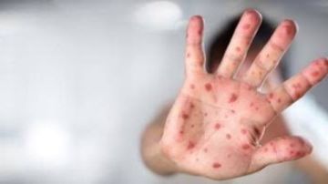 إغلاق الحضانات.. علامات مبكرة لإصابة ابنك بالفيروس المنتشر بالمدارس