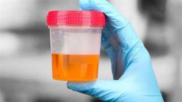 أعراض صديد البول وشكله .. كيف تعالجه نهائيا؟