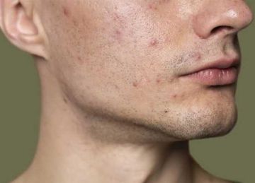 6 طرق فعالة للتخلص من آثار الحبوب واستعادة نضارة البشرة 6 طرق فعالة للتخلص من آثار الحبوب واستعادة نضارة البشرة