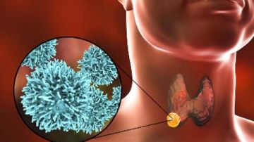 سرطان الغدة الدرقية.. أهم 7 طرق للوقاية