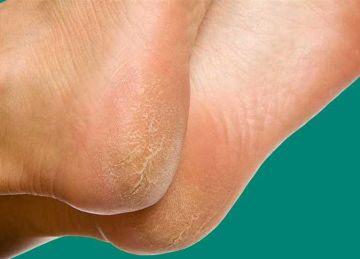 استخدمي العسل.. حيل لعلاج تشققات الكعبين