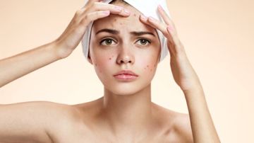 روتين علاجي صارم.. خطة من 5 خطوات للتخلص من حب الشباب