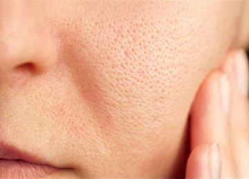 بطريقة آمنة وفعالة.. إزاي تتخلصي من المسام الواسعة وتحافظي على نعومة بشرتك؟ بطريقة آمنة وفعالة.. إزاي تتخلصي من المسام الواسعة وتحافظي على نعومة بشرتك؟