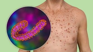 لو شاكك فيه.. إزاي تتأكد من إصابتك بفيروس ماربورج