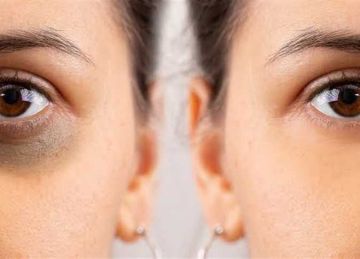 مش قلة النوم بس.. 8 أسباب طبية وراء الهالات السوداء وكيفية معالجتها بذكاء