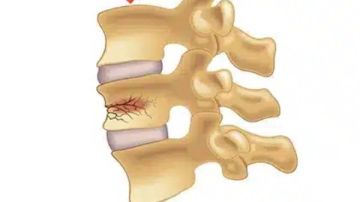 أمل جديد.. نهج طبي واعد لعلاج كسور العمود الفقري تفاصيل أمل جديد.. نهج طبي واعد لعلاج كسور العمود الفقري تفاصيل