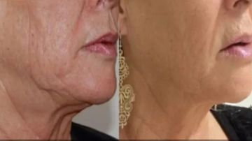 حكم إجراء عملية شد الوجه لإزالة التجاعيد.. الإفتاء توضح