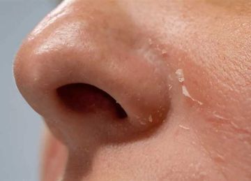  وشك بيقشر .. 3 علاجات فعالة لإصلاح حاجز البشرة