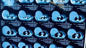 المريض تحمل 480 جنيها..استئصال ورم يزن 6 كيلو من جدار الصدر ببورسعيد