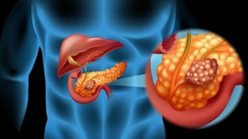 كل ما تريد معرفته عن سرطان البنكرياس.. احذر السمنة والتدخين