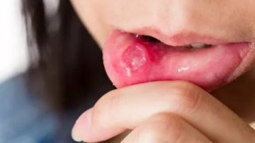 نشرة المرأة والمنوعات علامة مبكرة لسرطان الفم أو الحلق .. مادة تعيد بناء الأسنان من الداخل وتفتح بابا لعصر الشفاء الذاتي