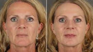 أكتر مشكلة بتدمر الشكل.. كيفية منع التجاعيد وتقليلها