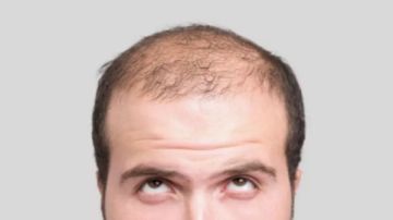 اكتشاف مصل جديد لإعادة نمو الشعر خلال 20 يوما تفاصيل