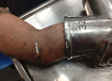 علقت يده داخل مفرمة اللحوم.. نجاح فريق طبى بمستشفى العجمى في إنقاذ جزار من الموت