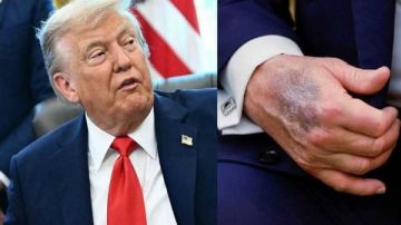 تورم الساقين وكدمات اليد.. هل يخفي البيت الأبيض حقيقة مرض ترامب بعد زيارة غامضة للمستشفى؟