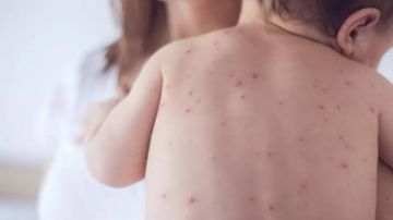 يديعوت أحرونوت : قلق في إسرائيل من انتقال عدوى مرضى الحصبة إلى الأطباء يديعوت أحرونوت : قلق في إسرائيل من انتقال عدوى مرضى الحصبة إلى الأطباء