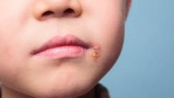 الهربس عند الأطفال.. كيف تميز أعراض المرض وسط تشابهها مع نزلات البرد؟ الهربس عند الأطفال.. كيف تميز أعراض المرض وسط تشابهها مع نزلات البرد؟