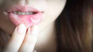 تستمر لأكثر من أسبوعين.. علامة مبكرة لسرطان الفم أو الحلق تستمر لأكثر من أسبوعين.. علامة مبكرة لسرطان الفم أو الحلق