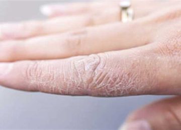 مع اقتراب فصل الشتاء.. 3 خطوات ضرورية لحماية البشرة من الجفاف