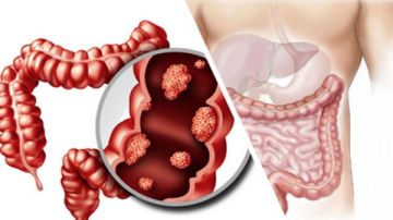 4 علامات بارزة.. أعراض مبكرة لسرطان القولون والمستقيم