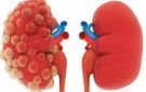 الفشل الكلوي.. أعراضه وطرق الوقاية منه