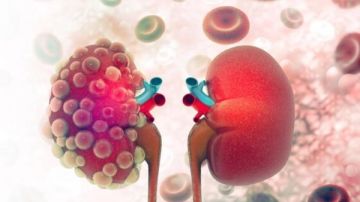 بتخليك لا عارف تاخد مسكنات ولا أدوية.. طرق الوقاية من أمراض الكلى